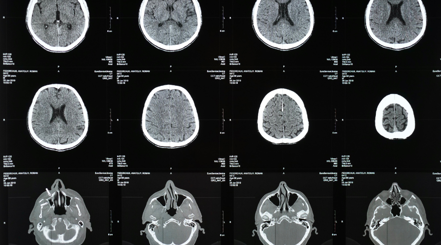surviving ruptured brain aneurysm surviving a ruptured brain aneurysm